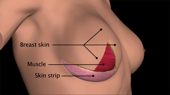 Still from the DVD guide to breast reconstruction