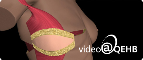 Still image from the guide to breast reconstruction DVD
