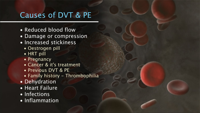 Still from "A guide to hospital-acquired deep vein thrombosis and pulmonary embolism"