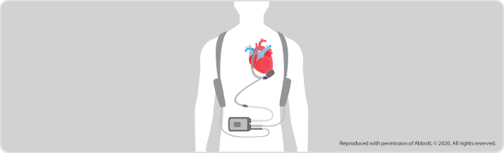 Left Ventricular Assist Device (LVAD) illustration