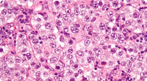 Seminoma (testicular cancer) cell